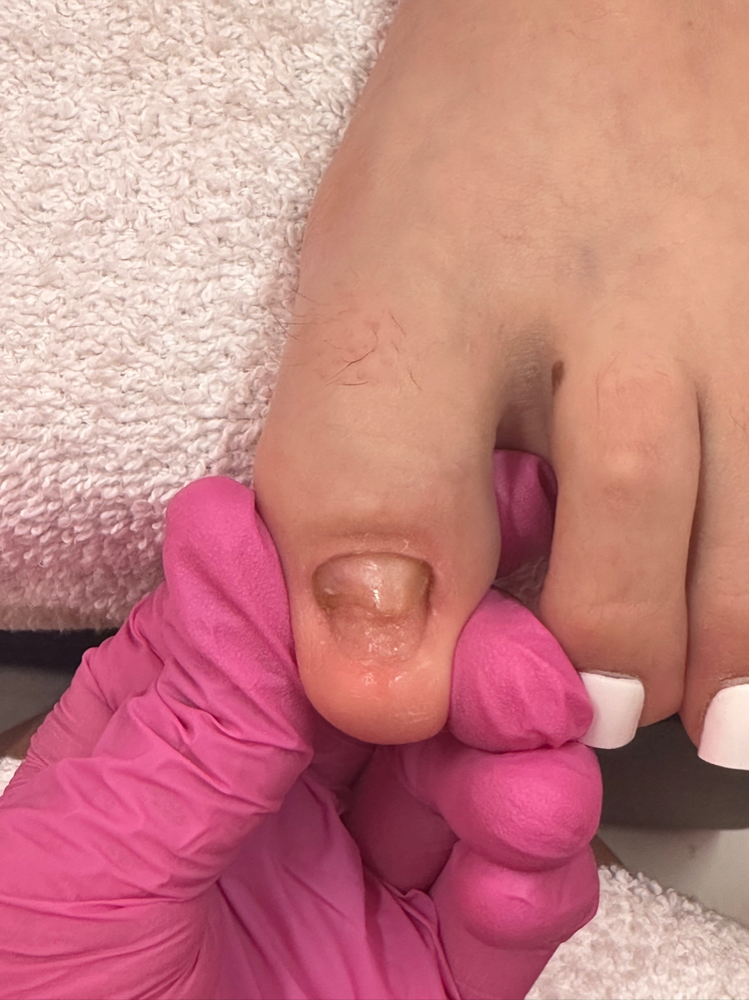 Fungal Treatment Pedi 1st Session