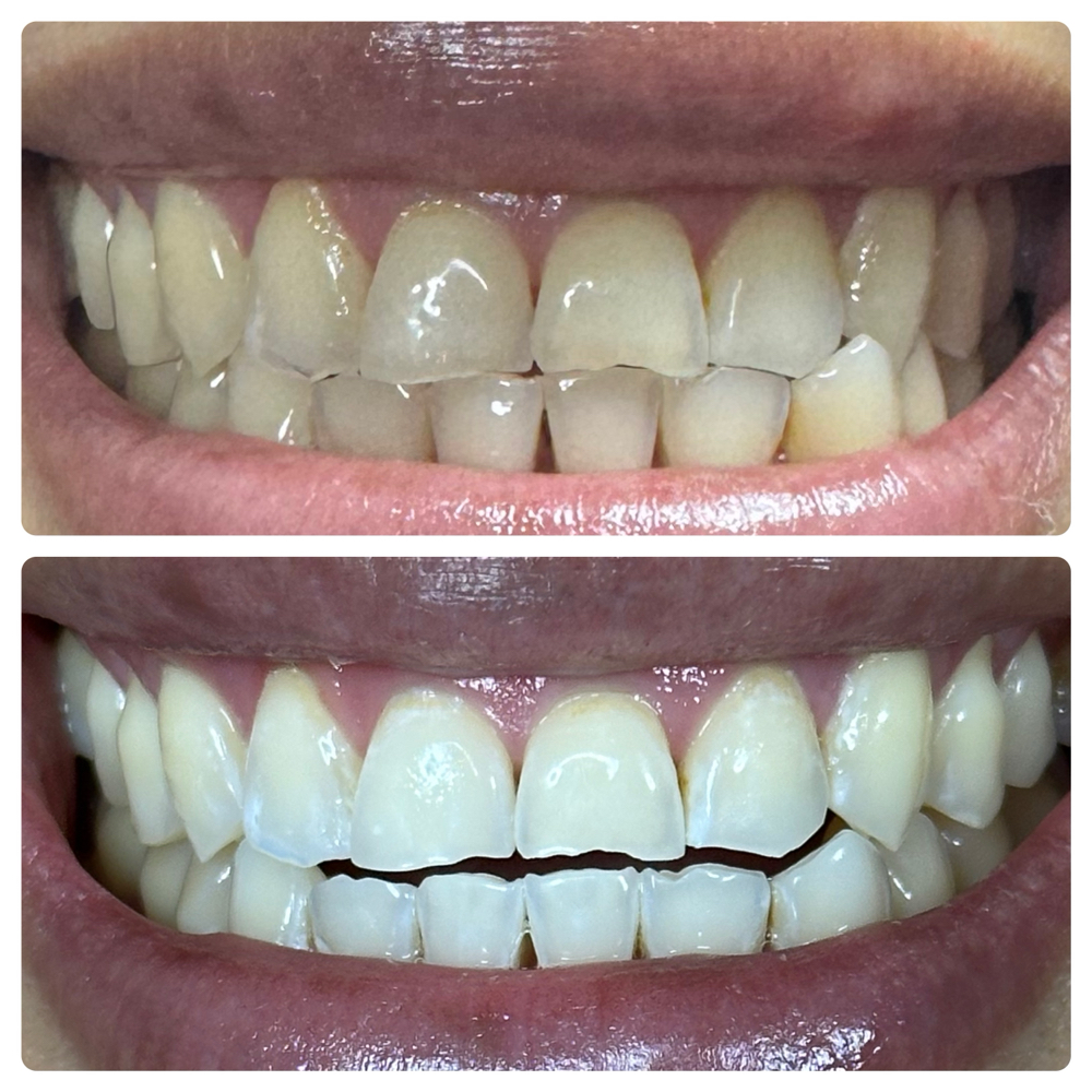 Teeth Whiteing