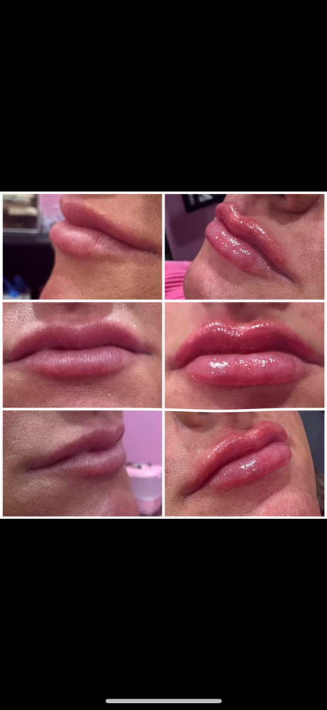Lip Filler (1/2 Syringe)