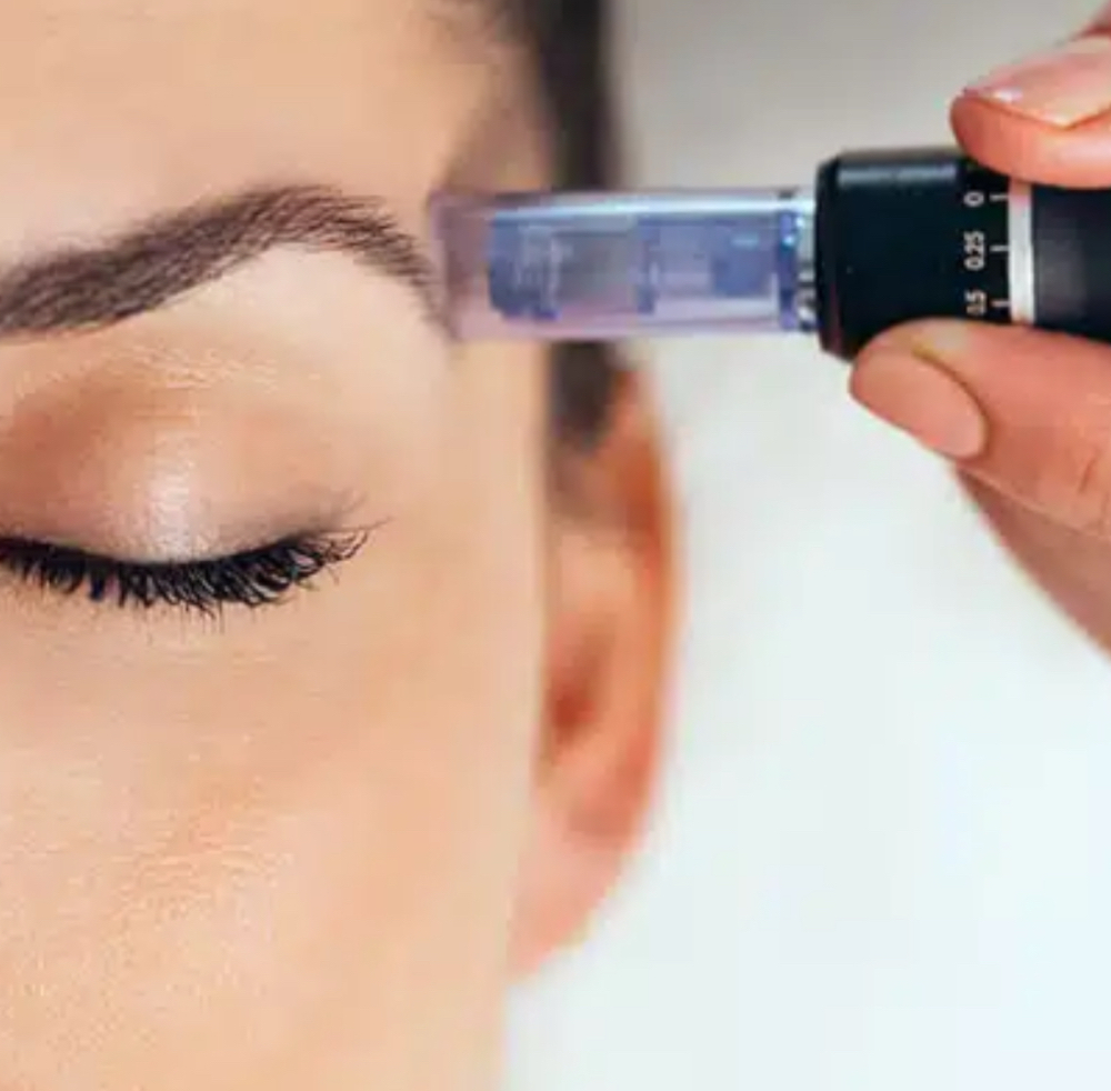 Microneedling