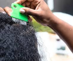 Excessive Dandruff Removal