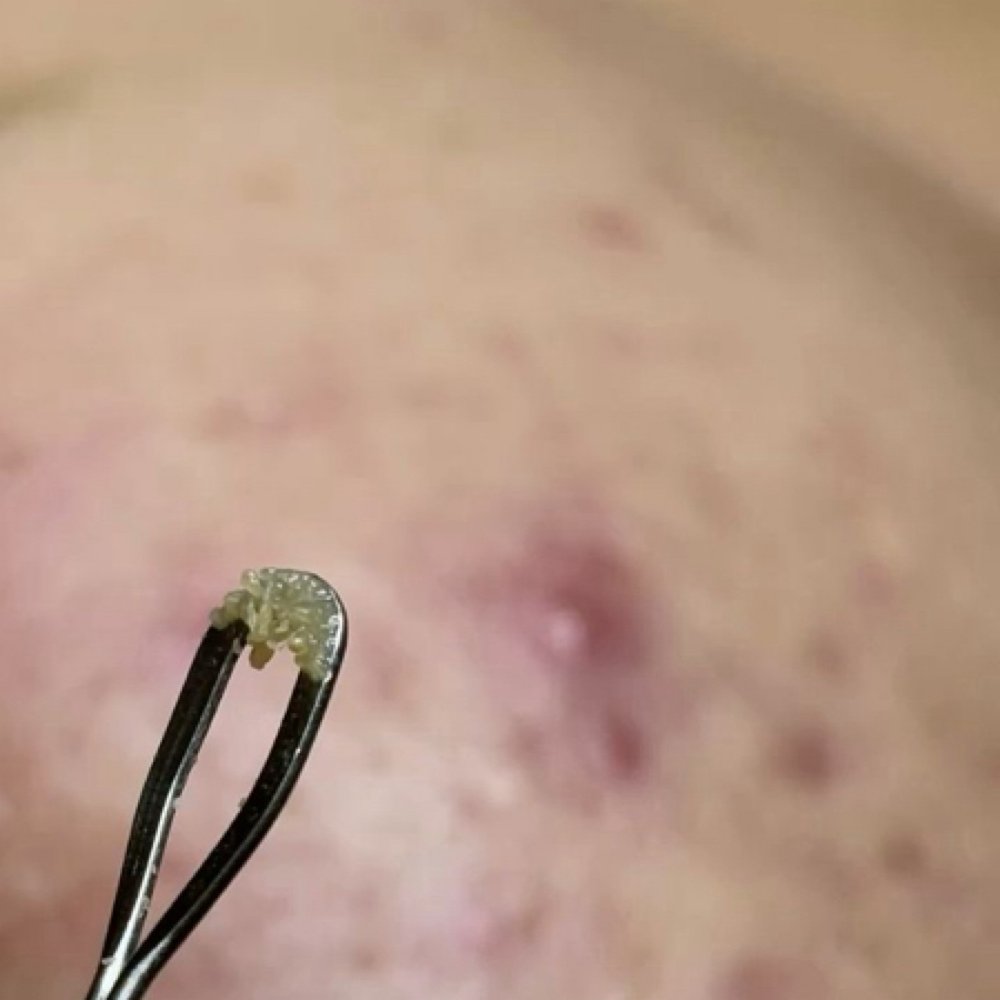 Acne & oil detox facial at Aries Beauty & Wellness in Chandler, AZ