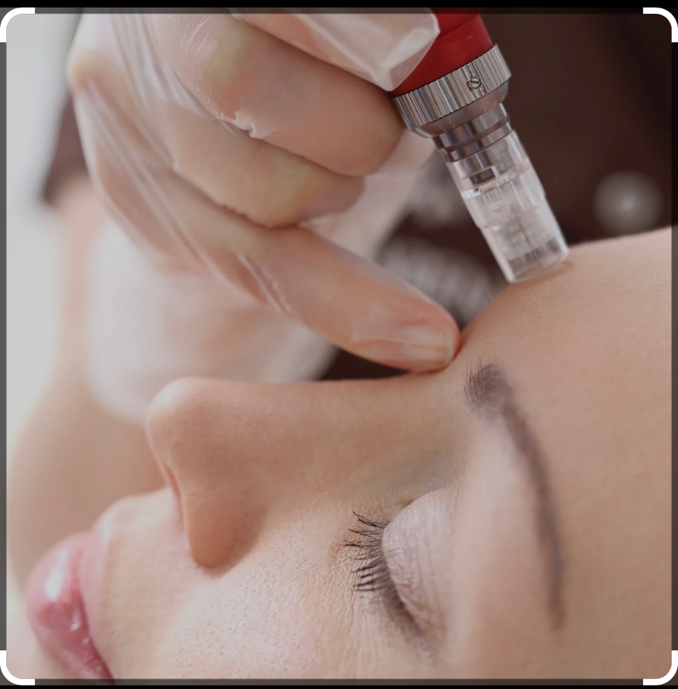 Microneedling