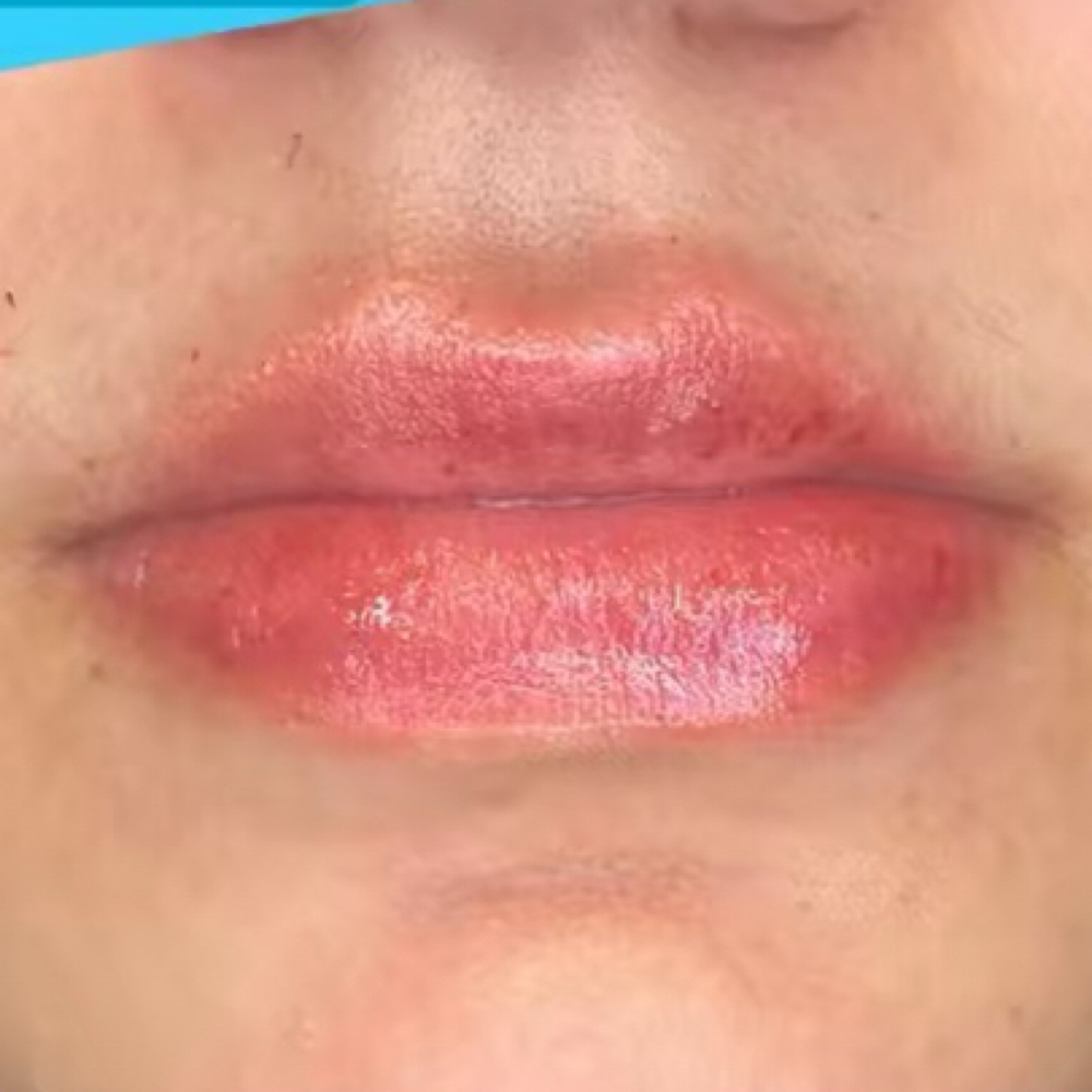 Lip Flip - 1 ML at 210 The Body Bar | San Antonio Lux Spray Tans & Body Sculpting in San Antonio, TX