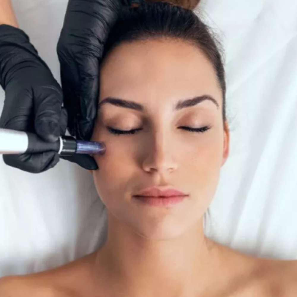 Microneedling(Face+Neck+Chest) at Skin by Cydni in Atlanta, GA