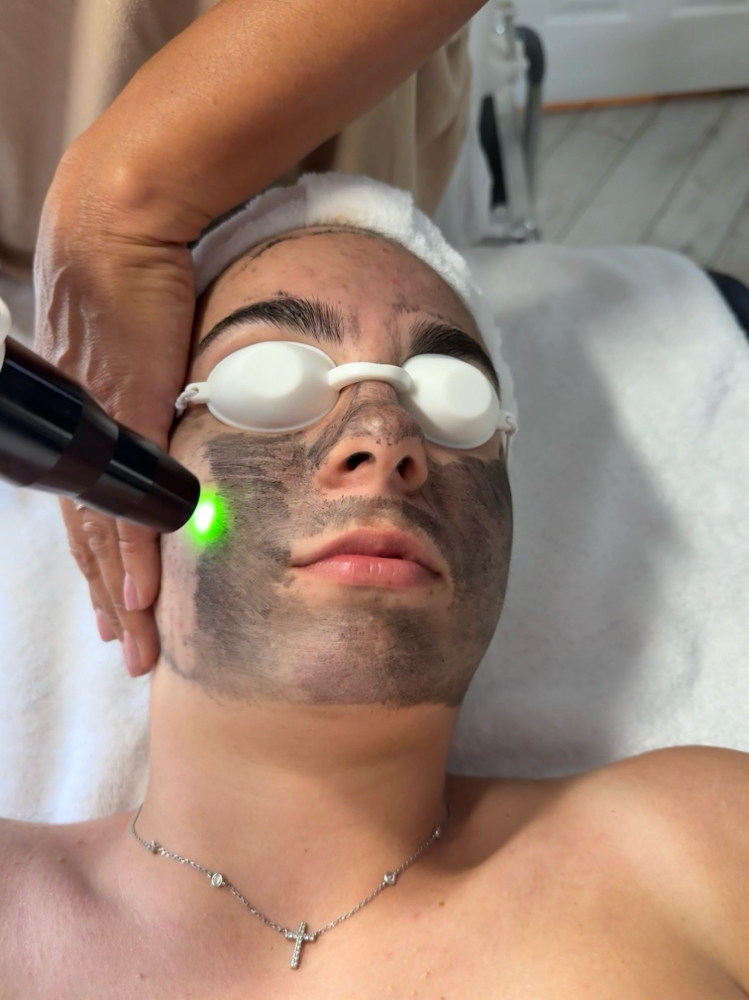 Carbon Laser Facial at Marina Novak in North Palm Beach, FL