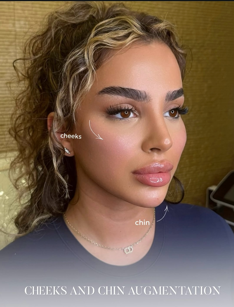 Cheek Filler