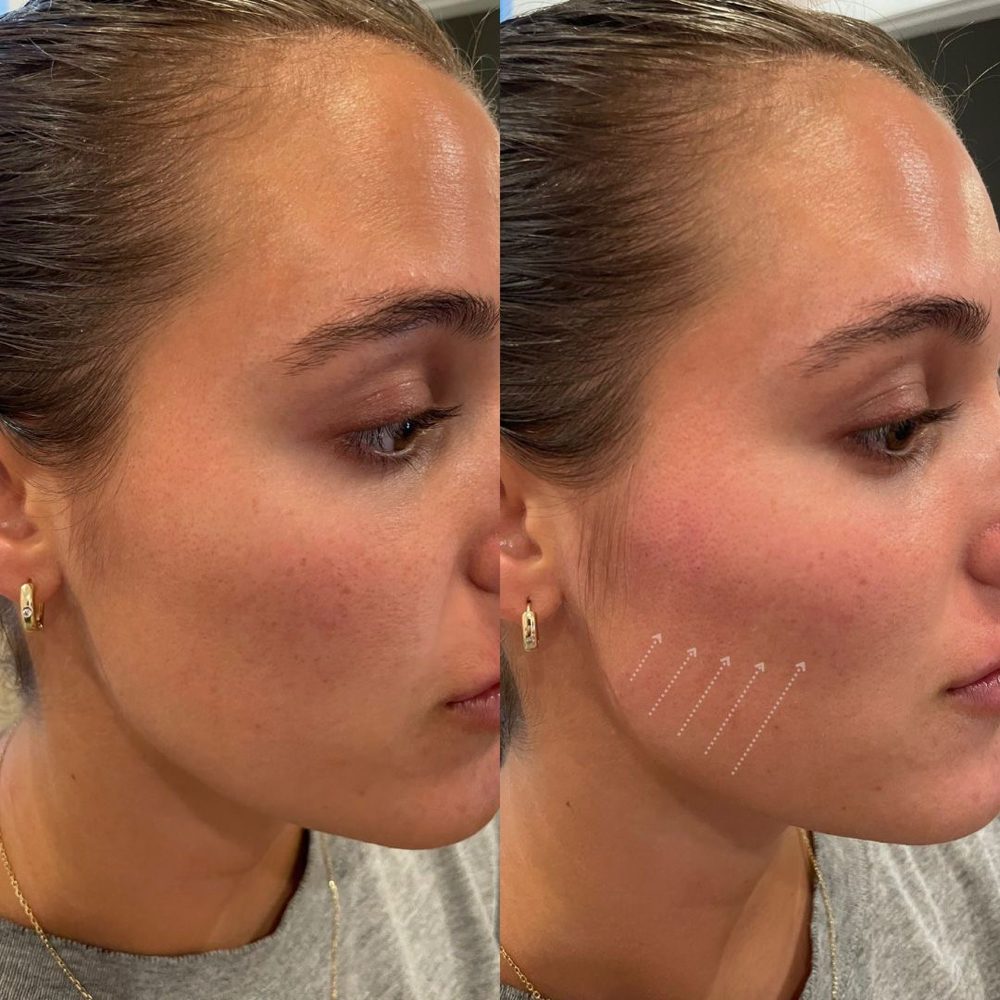 Cheek Filler at La Belle Aesthetics & Wellness in Hellertown, PA
