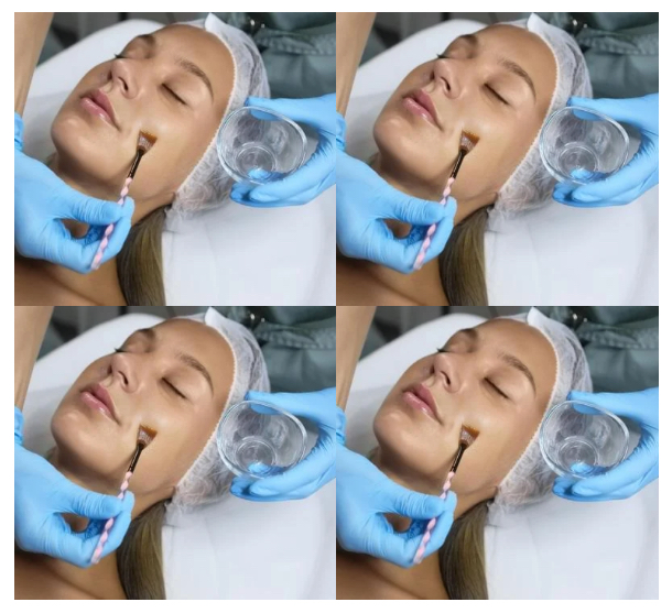 4-Series Chem Peel