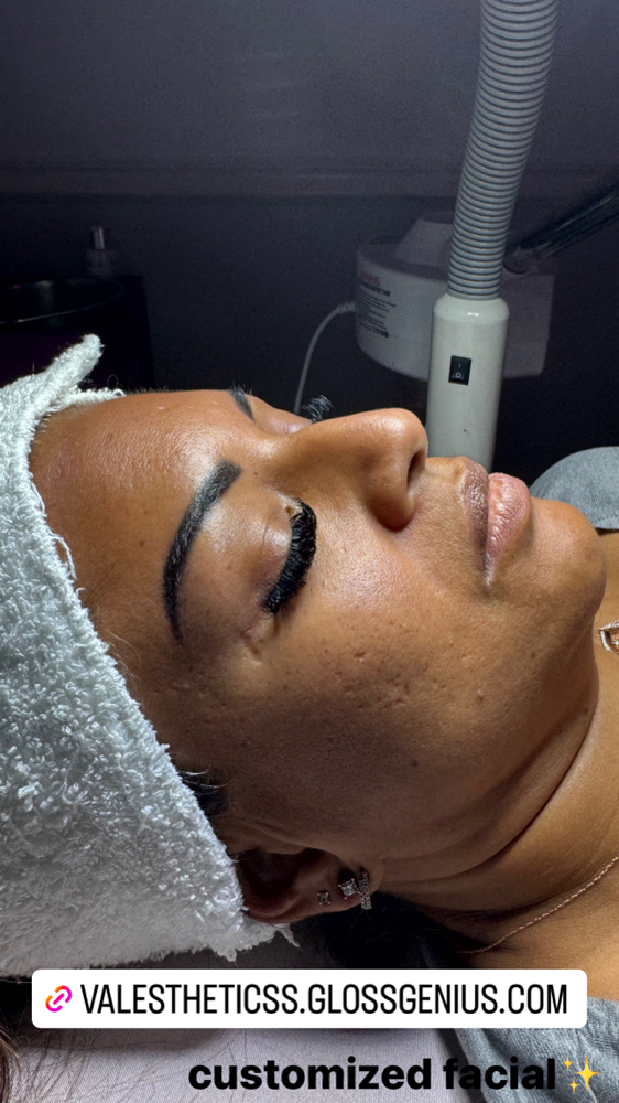 Chemical peel