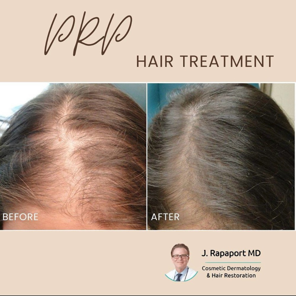 Platelet-rich Plasma (PRP) Therapy At Englewood Cliffs