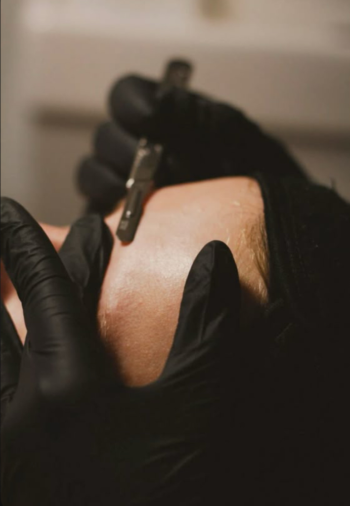 Dermaplaning treatment