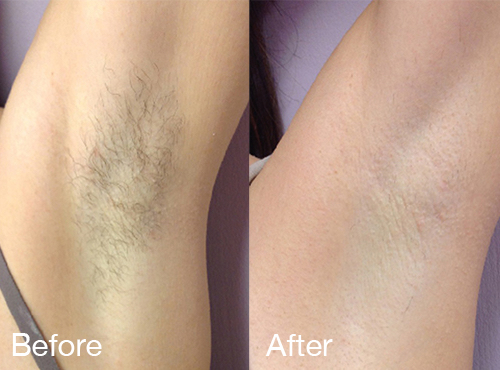 SMALL AREA - Laser Hair Removal