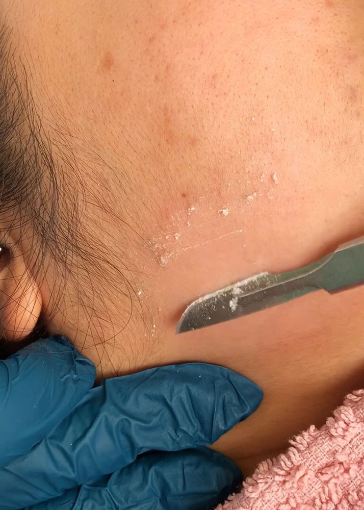 Dermaplane Facial