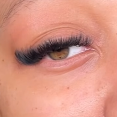 Volume Fill in at Refinery Aesthetics Loft in Oxon Hill, MD