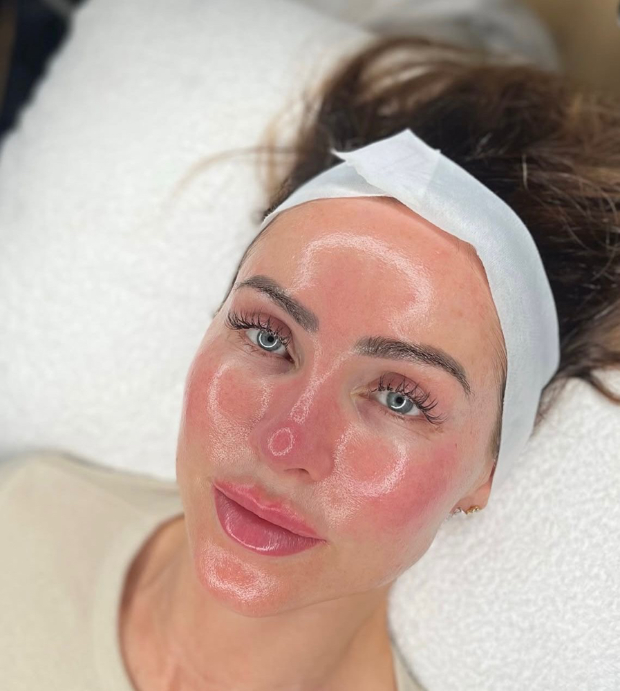 exosomes microneedling at glowbync_threadingandfacials in alpharetta, GA