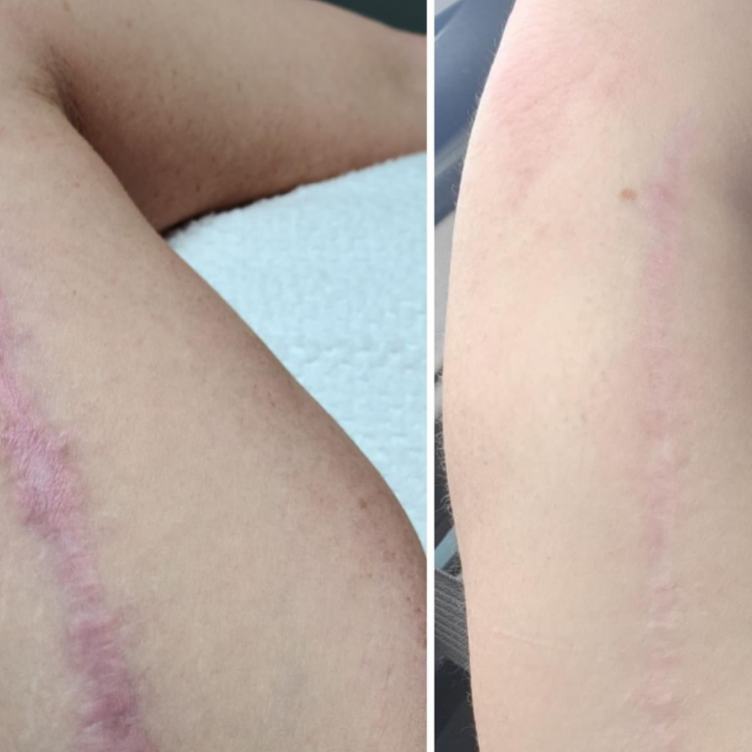 SCAR REVISION SESSION [LARGE SCARS] at GloVolution LLC in Homosassa, FL
