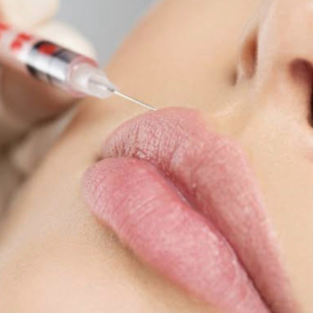 Lip flip at Revived Wellness & Aesthetics in Quincy, IL
