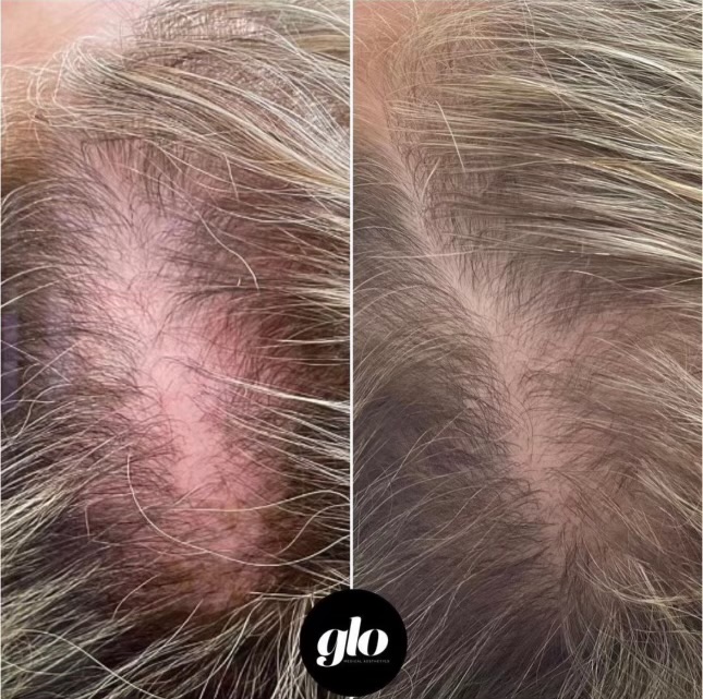 DeRive-Top Of Head- 1 Treatment
