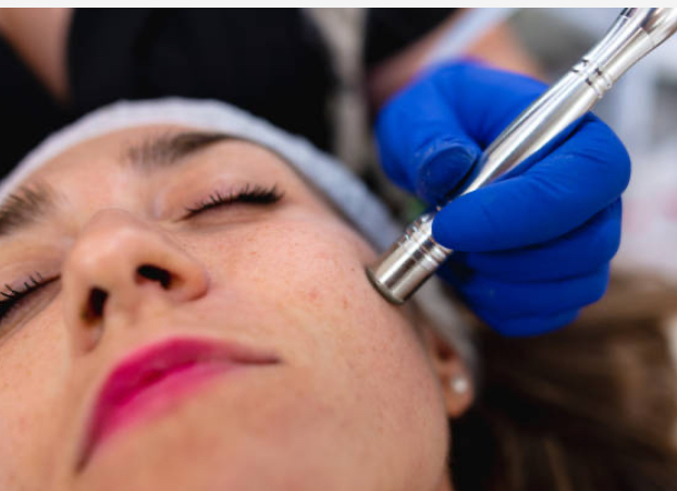 Microdermabraison