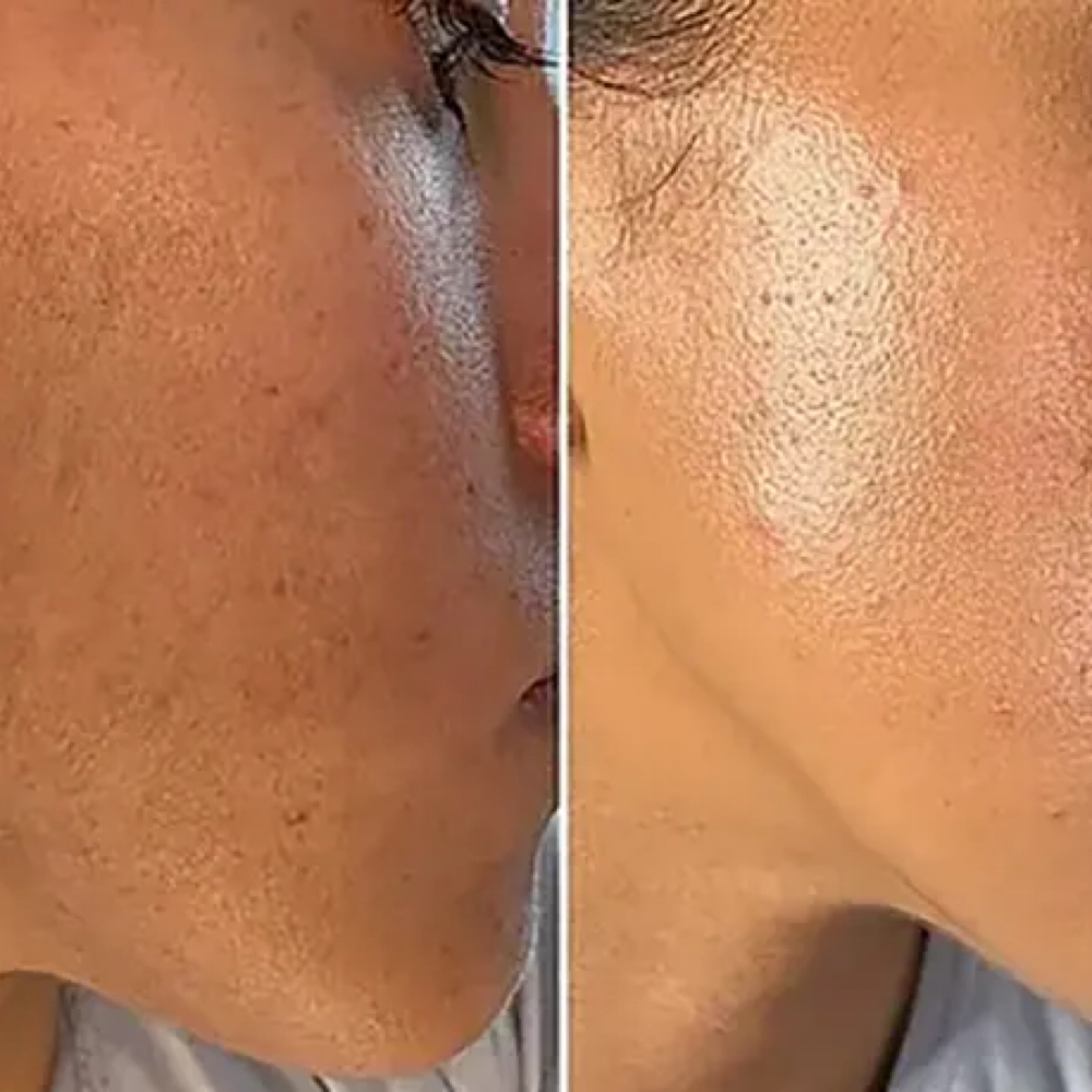 Dermaplaning Facial at Relaxation Zone in Charlotte, NC