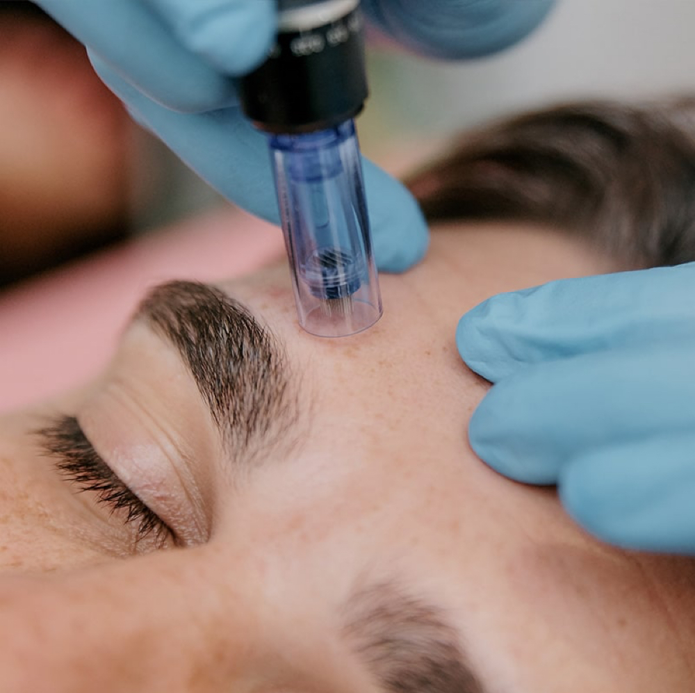 Custom MicroNeedling Facial at Brow Therapy in San Antonio, TX