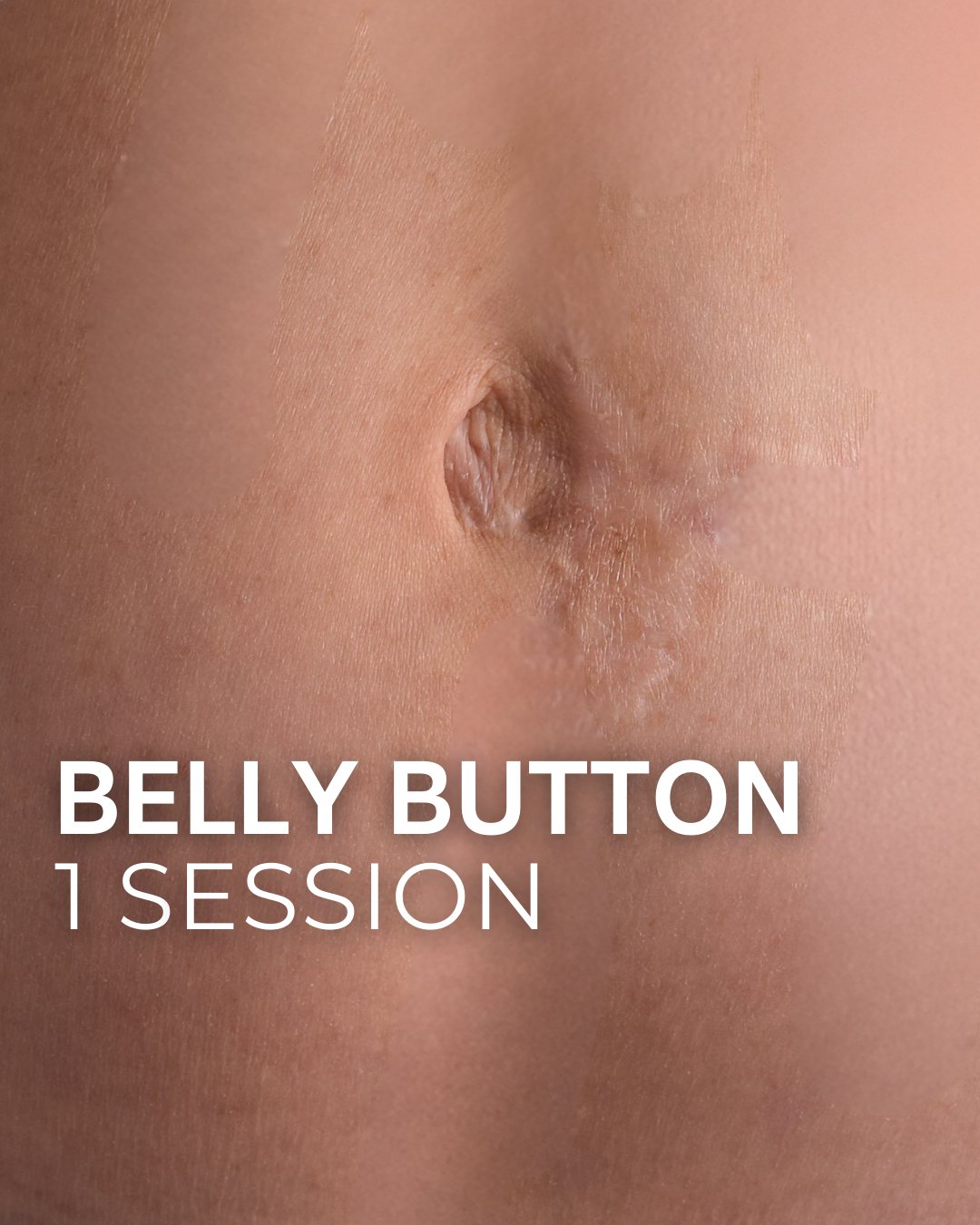 Belly Button - 1 Session at TRUE HUE AESTHETICS in Beverly Hills, CA