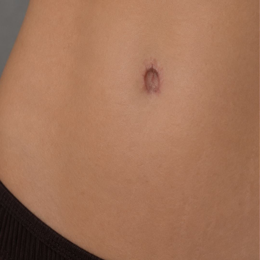 Belly Button Scar at TRUE HUE AESTHETICS in Beverly Hills, CA