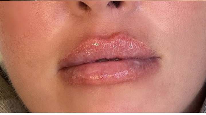 HA Lip Infusion Touch up