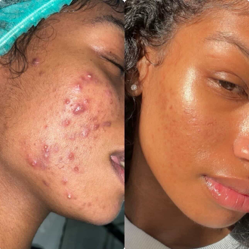 Organo Peel Model Call at Lumiére Skin Science in Atlanta, GA