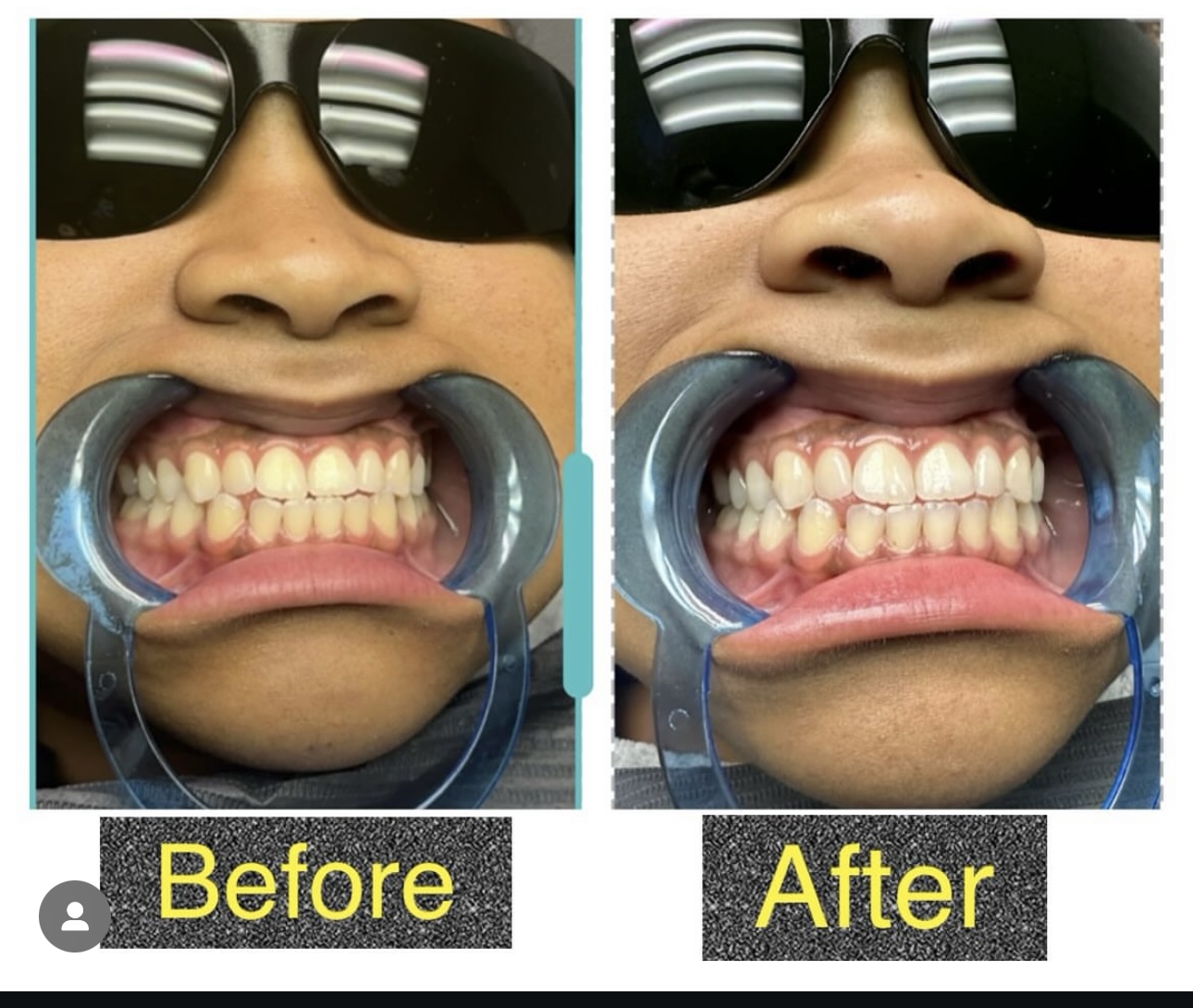 Teeth Whitning