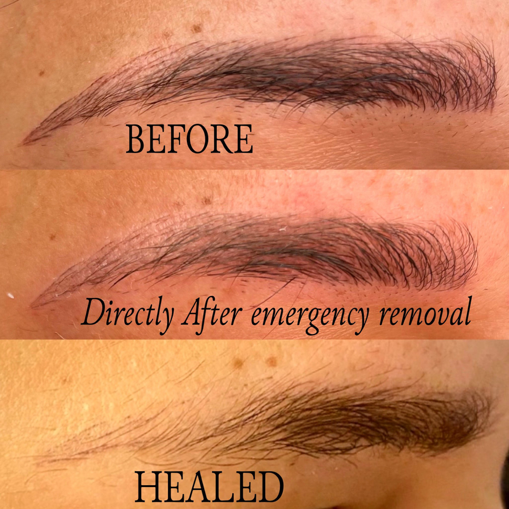 Emergency Tattoo Removal