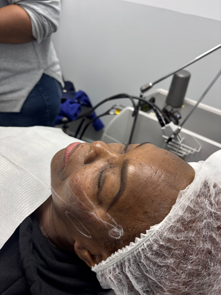 PDO Thread Llift at Arewa Essential Medspa in Mamaroneck, NY