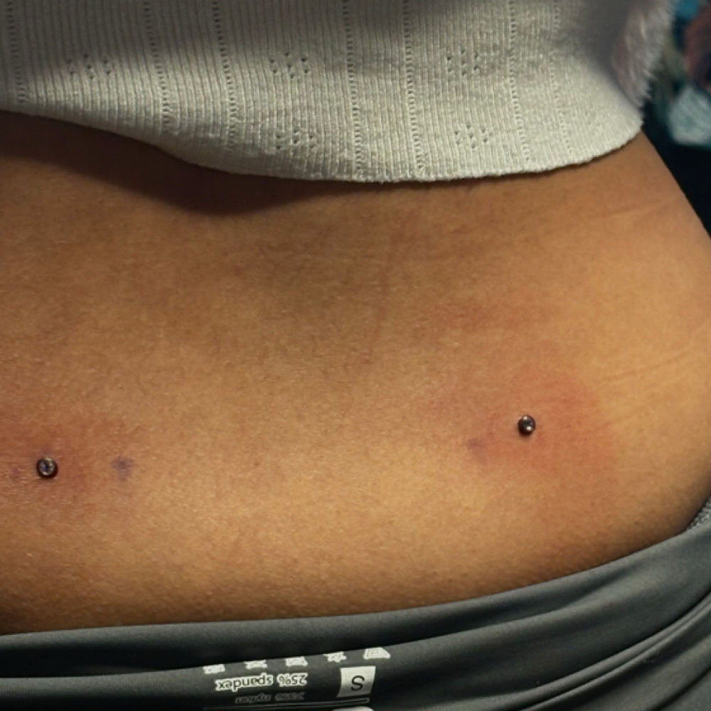 Back Dermals at PunkturedByKal in Arlington, TX