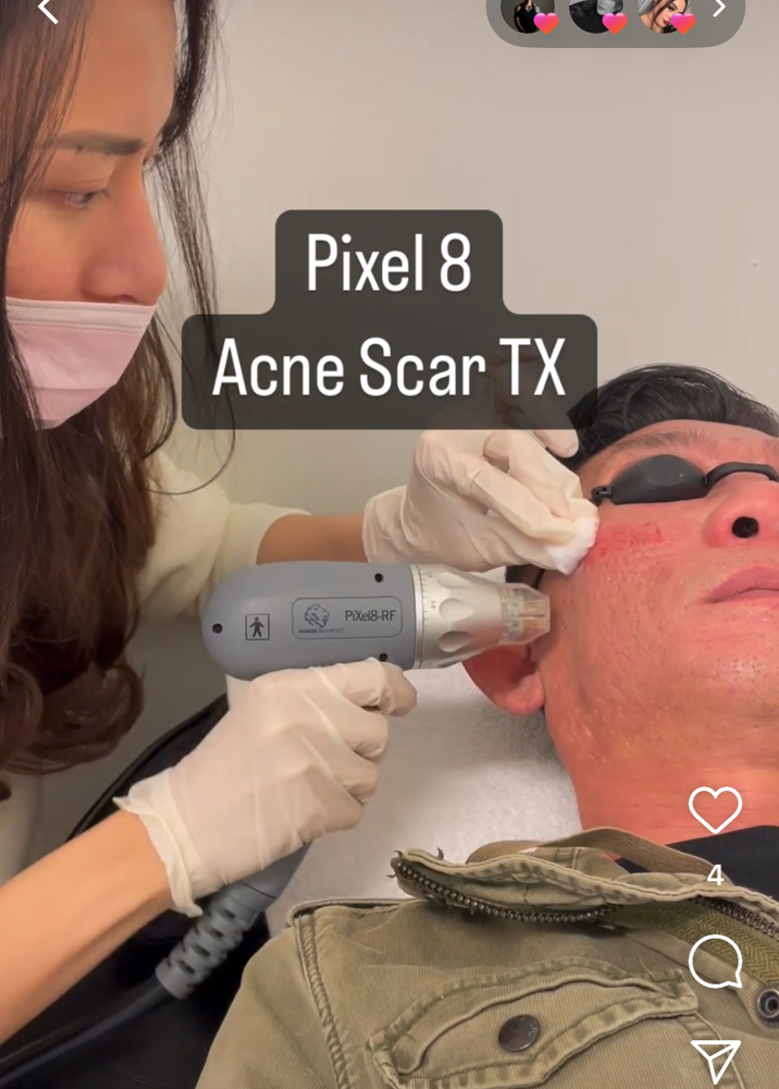 Pixel 8 Microneedling Package Of 6