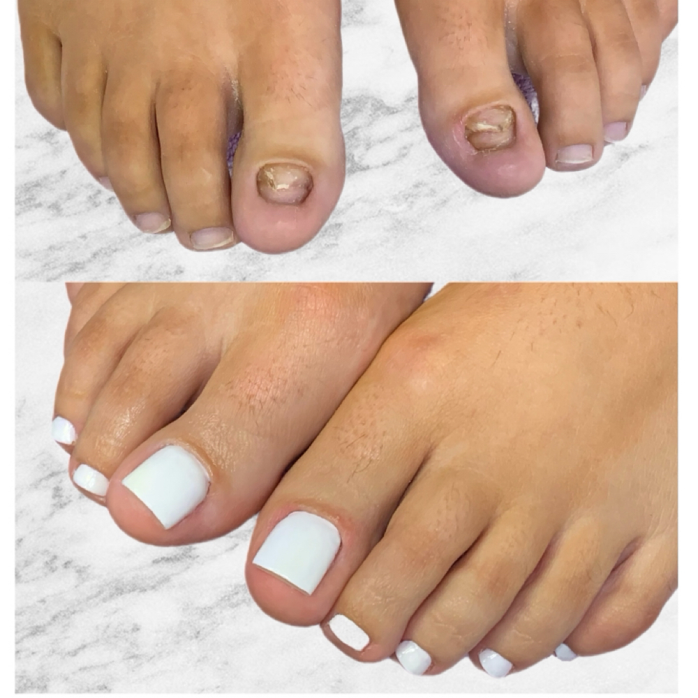 Big Toe Reconstruction at True artist studio in Goose Creek, SC