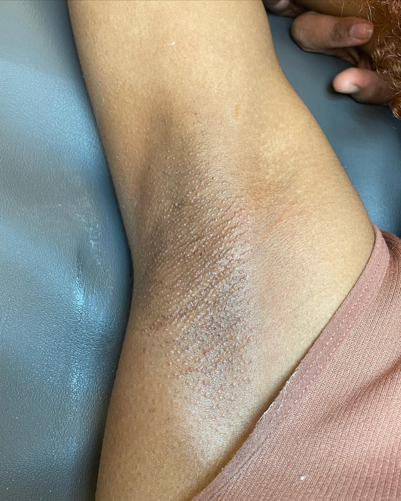 Underarm