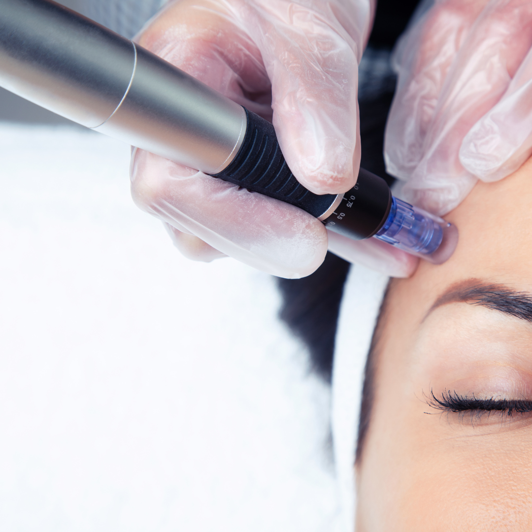 Microneedling Consultation