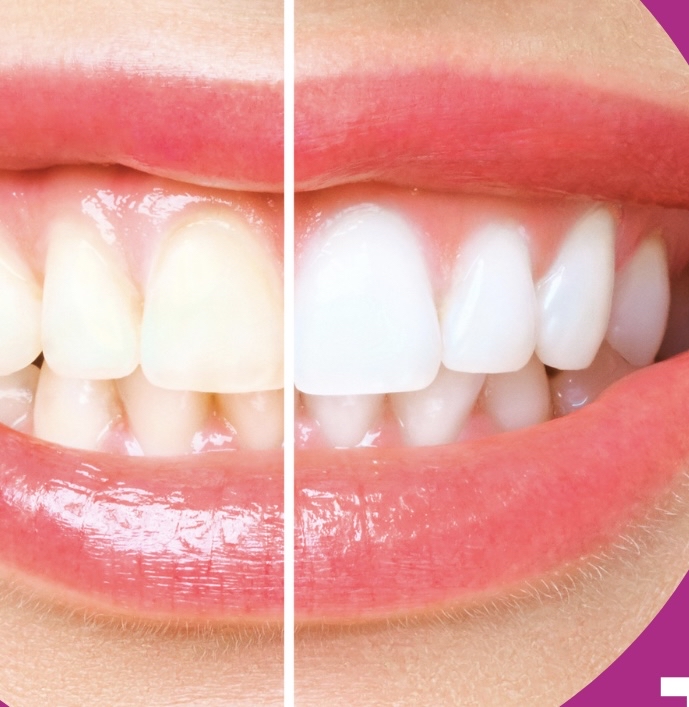 Cosmetic Teeth Whitening