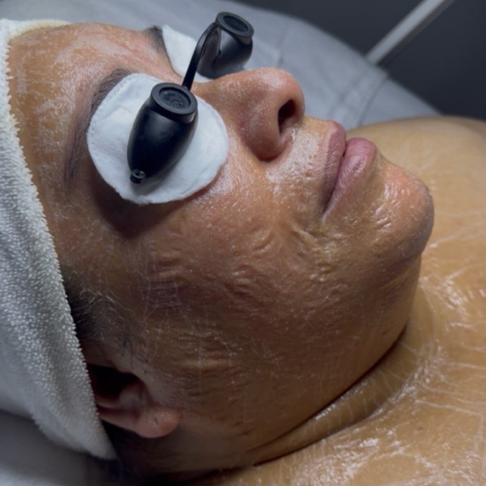 “ZOMBIE” FACIAL at Pura Belleza Aesthetics in Avondale, AZ
