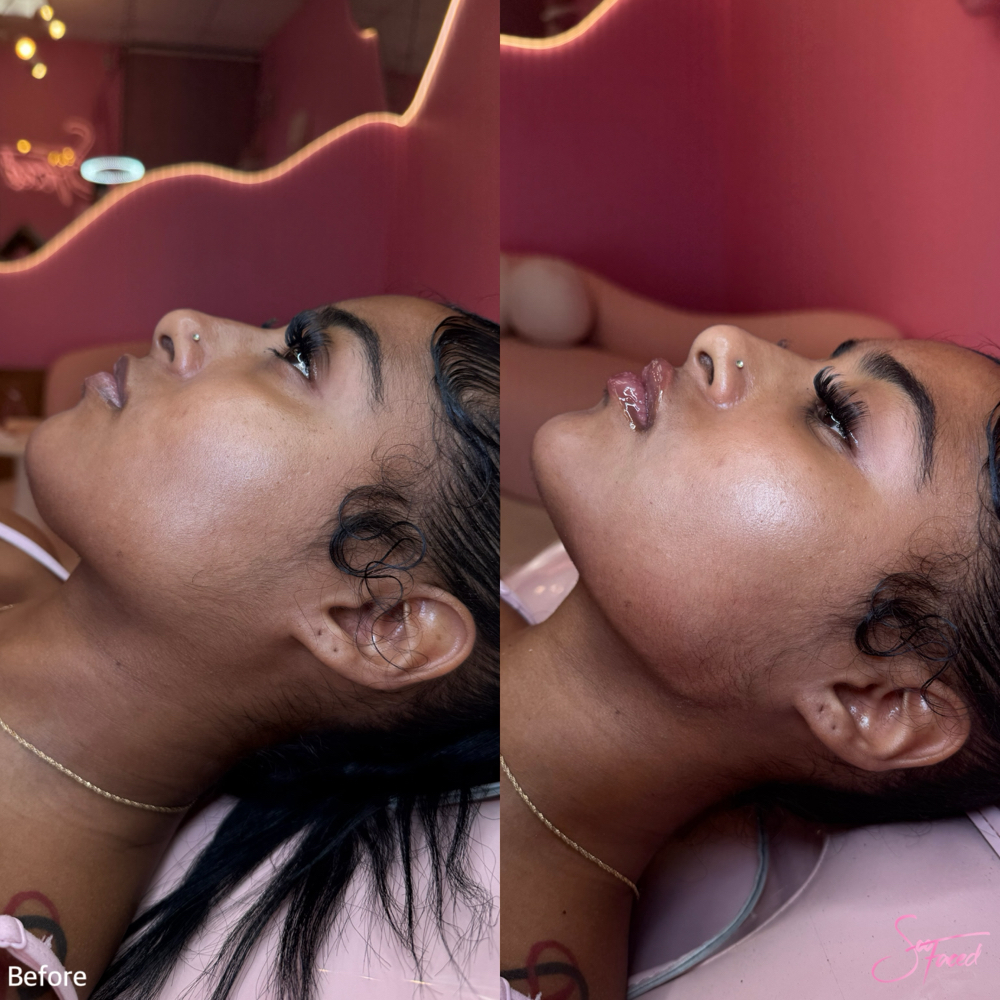 Jawline Definition