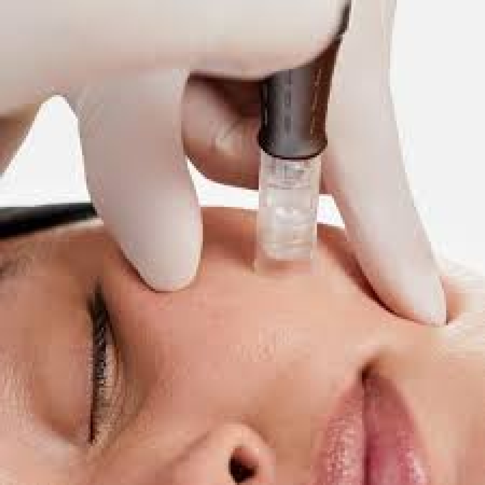 Nano Needling with Facial