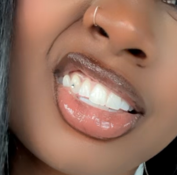 Ultimate Whitening + Gem Affixation