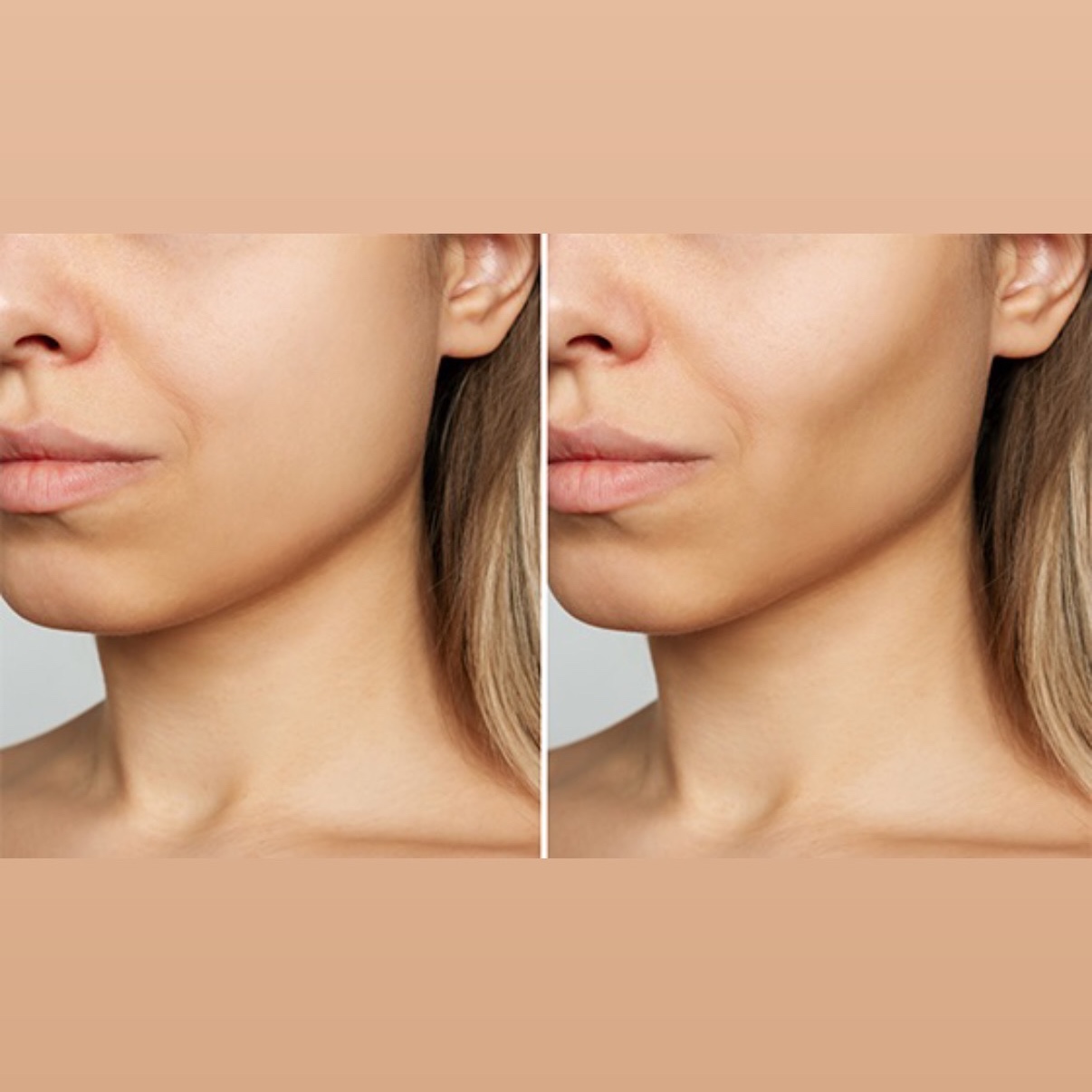 Lipo 360 Contour Cheeks at Gold Stone Beauty in mcallen, TX