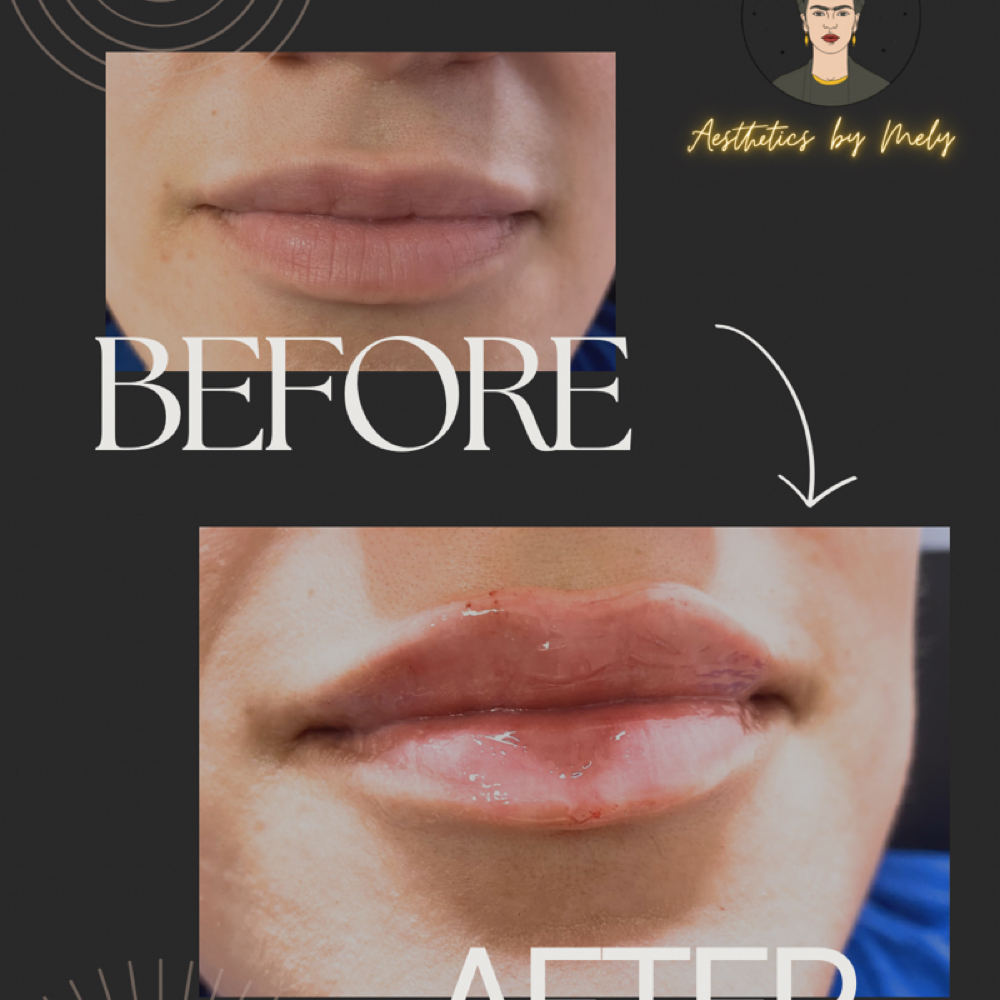 Full Syringe Lip Filler at Booking site for Mely & Kaila in Lubbock, TX