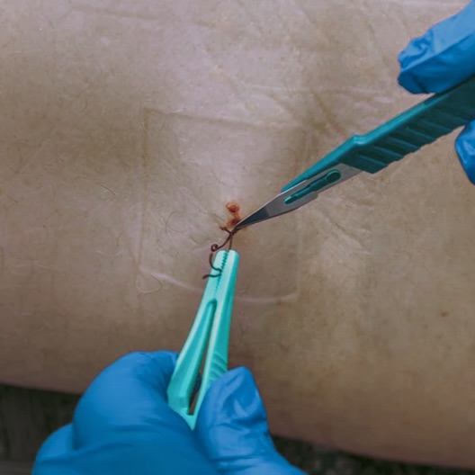 Stitches Removal (Non-Absorbable)