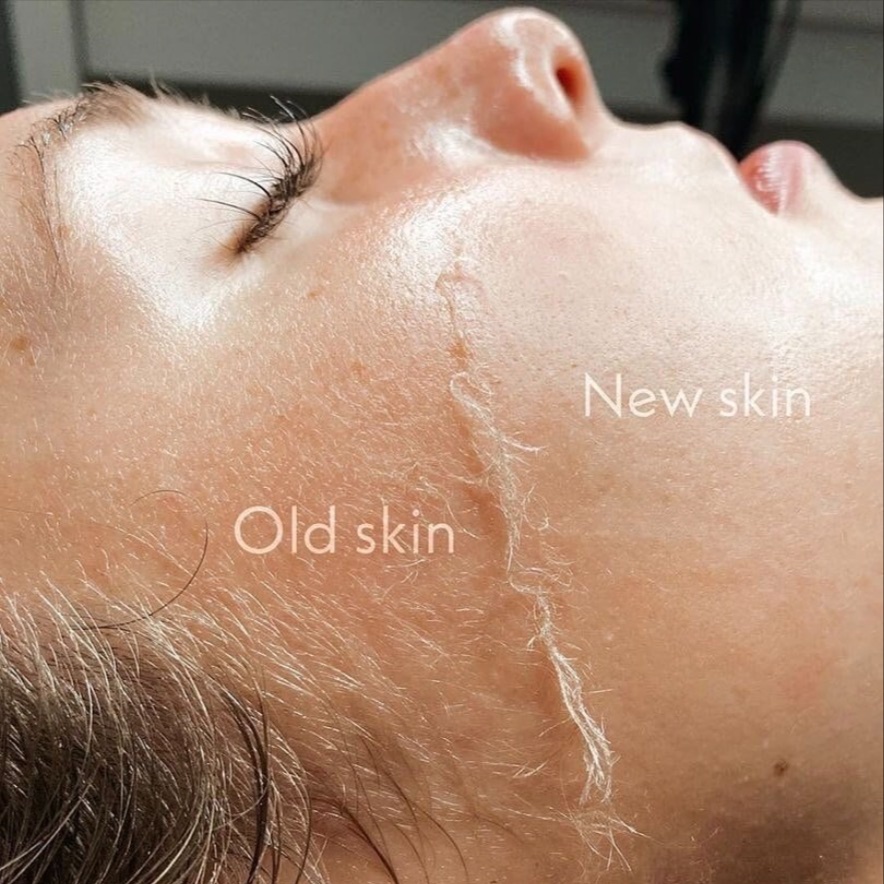 Dermaplane at Marisa Benakos in Chicago, IL