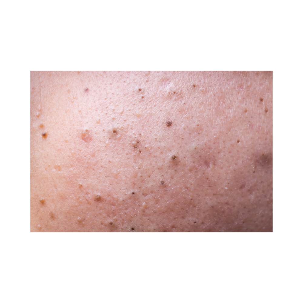 Pore Vacuum-Add It To Your Facial at Black Arch Studio in Jonesboro, GA