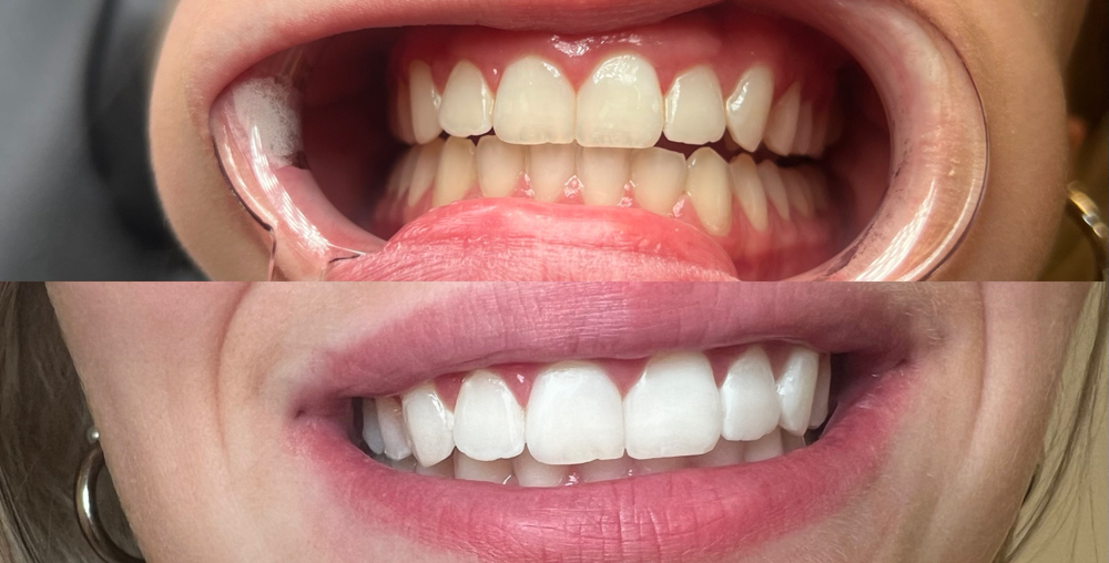 Teeth Whitening