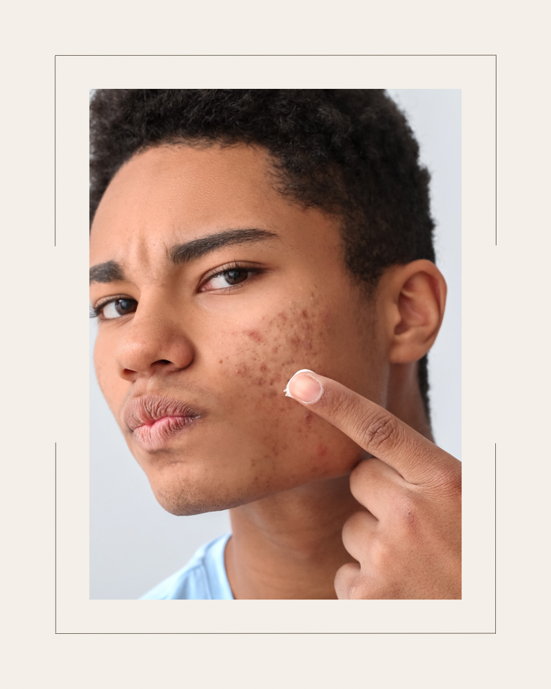 Customized Acne Treatment